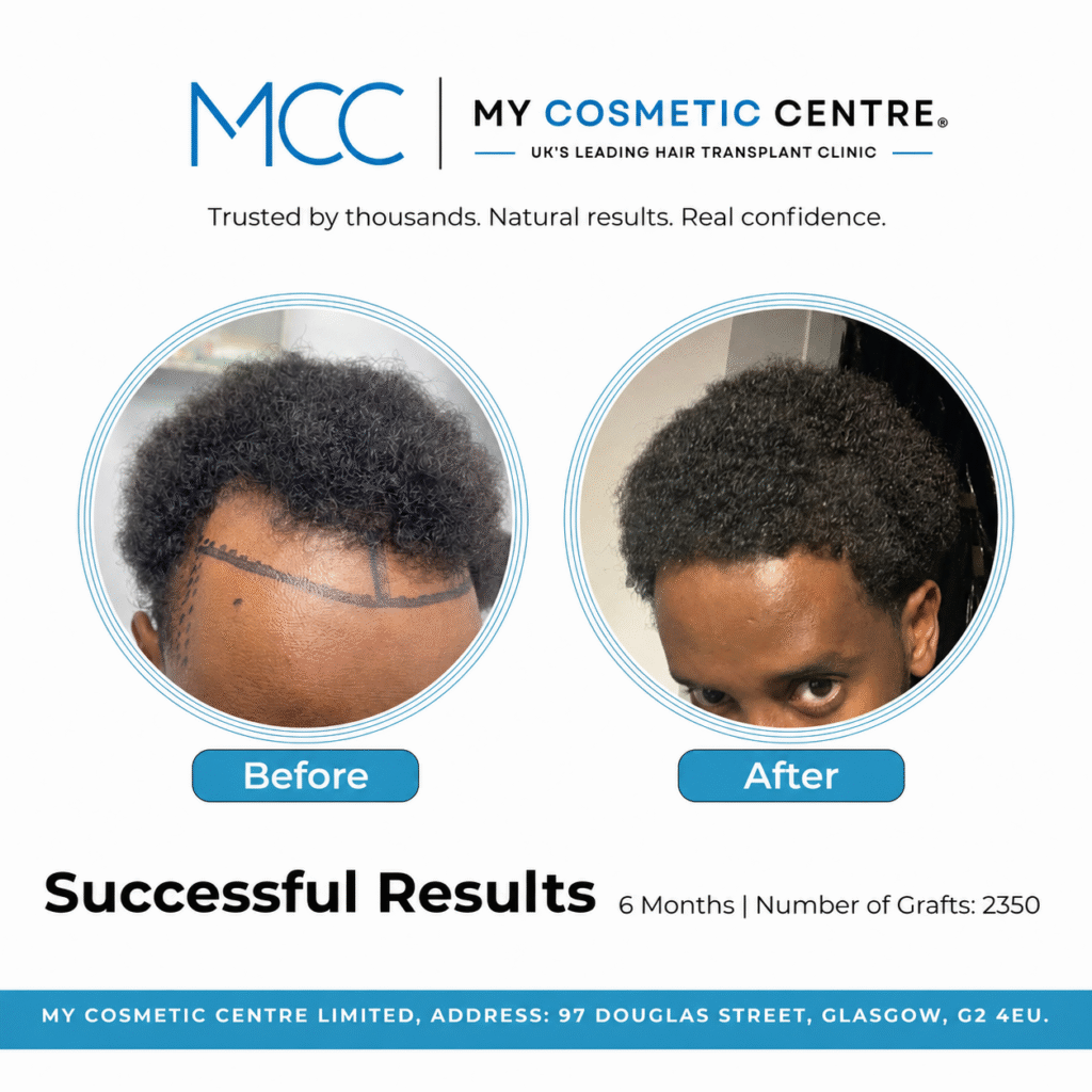 Before and after FUE hair transplant result at My Cosmetic Centre. Individual outcome, results vary.