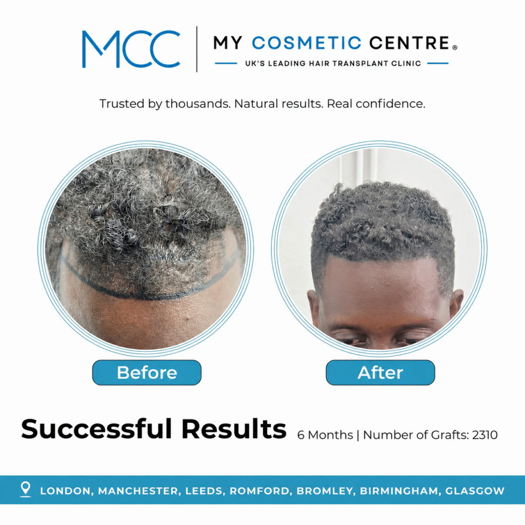 Before and after FUE hair transplant result at My Cosmetic Centre. Individual outcome, results vary.