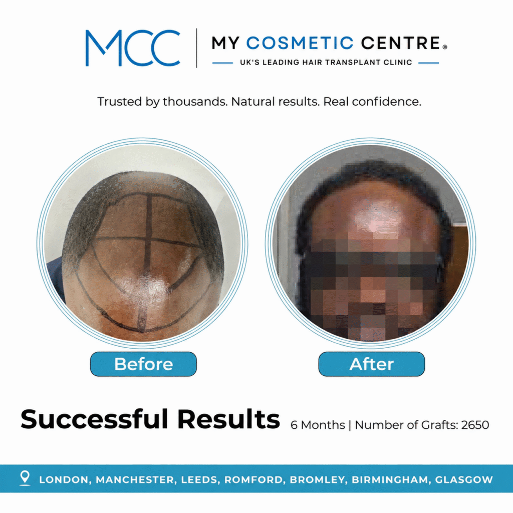 Before and after FUE hair transplant result at My Cosmetic Centre. Individual outcome, results vary.