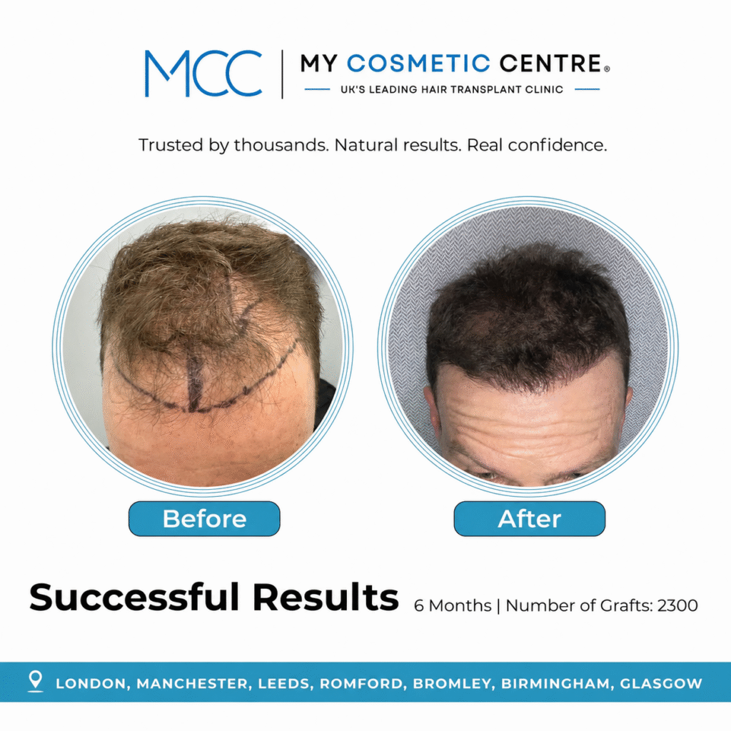 Before and after FUE hair transplant result at My Cosmetic Centre. Individual outcome, results vary.