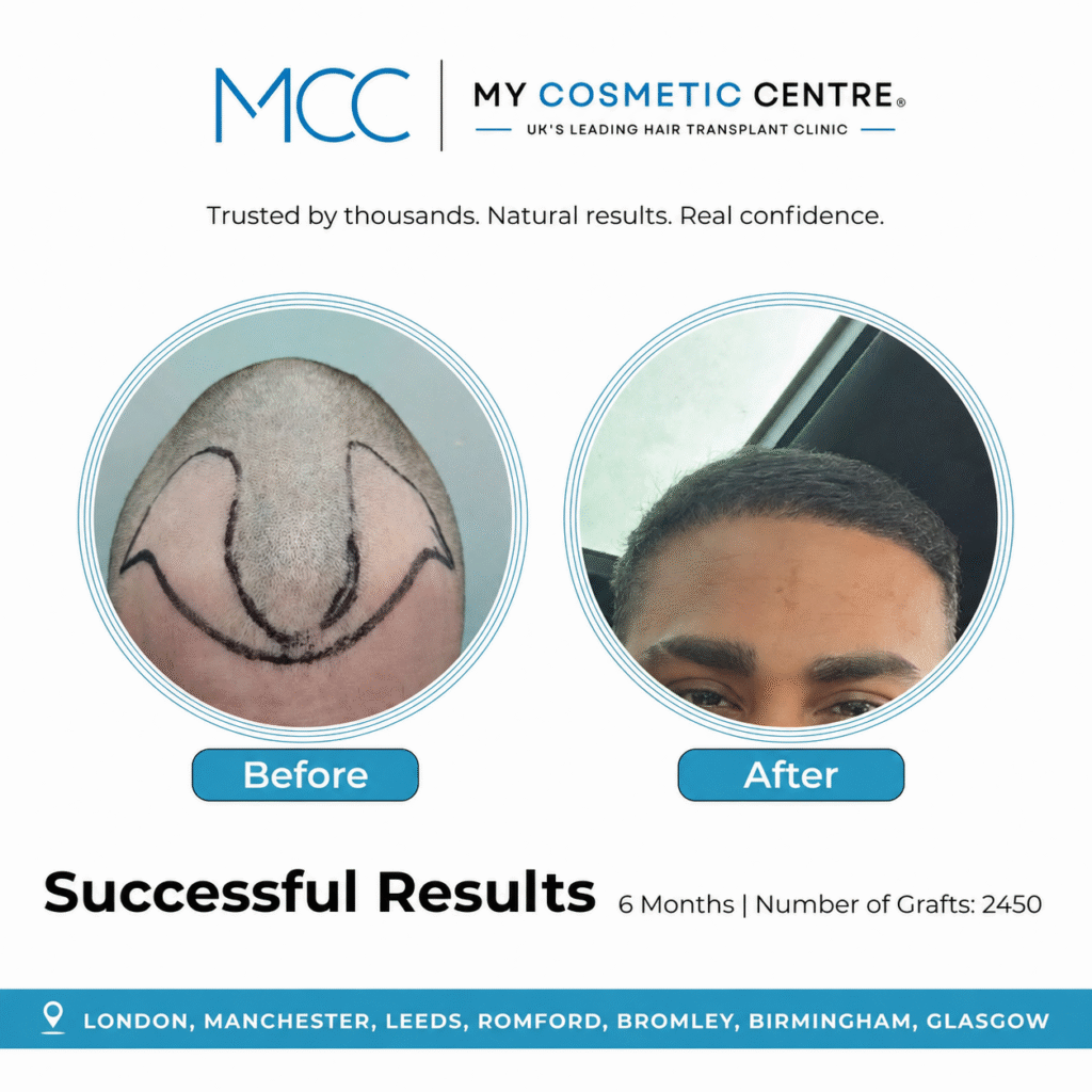 Before and after FUE hair transplant result at My Cosmetic Centre. Individual outcome, results vary.