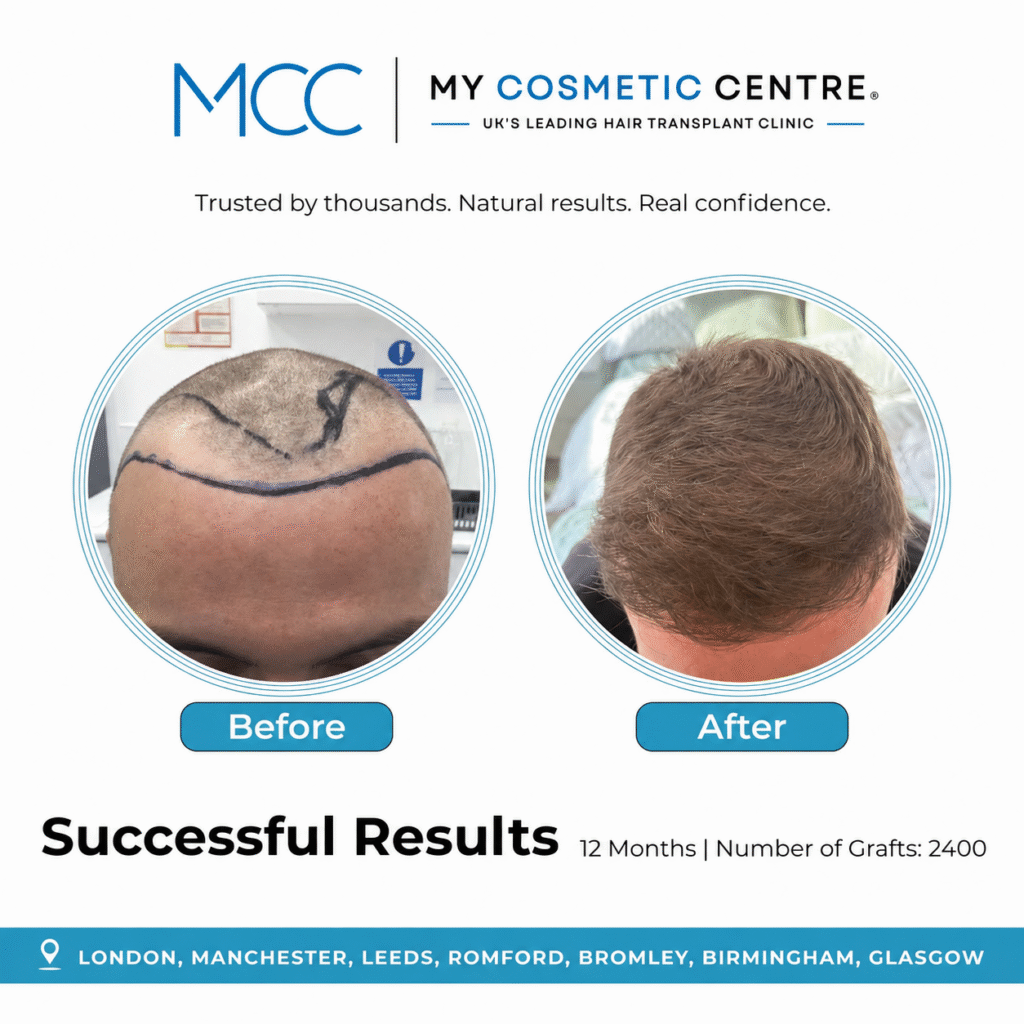 Before and after FUE hair transplant result at My Cosmetic Centre. Individual outcome, results vary.