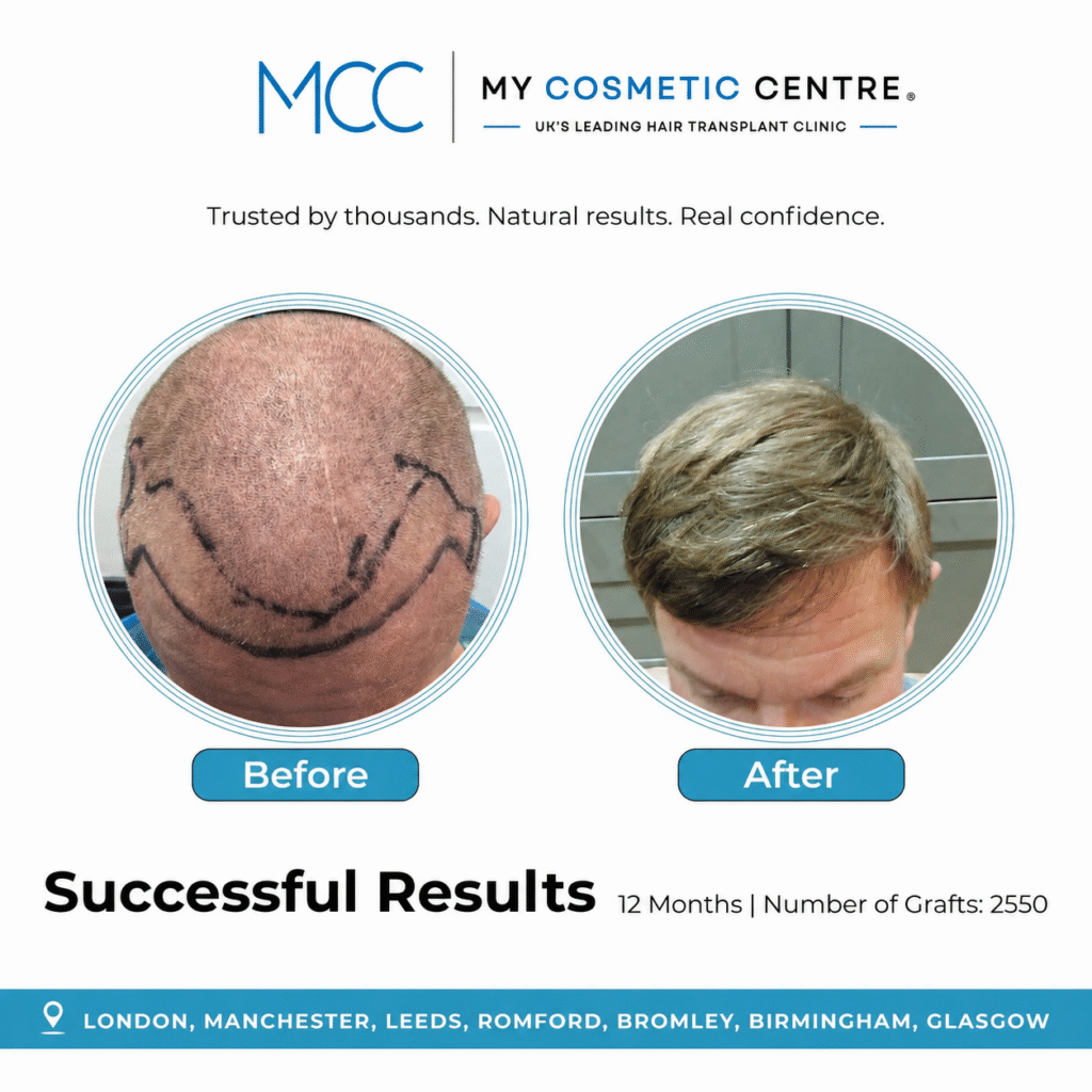 Before and after FUE hair transplant result at My Cosmetic Centre. Individual outcome, results vary.
