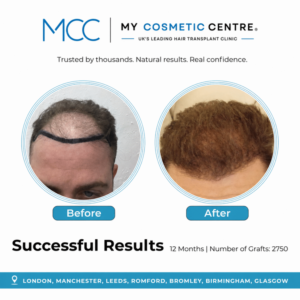 Before and after FUE hair transplant result at My Cosmetic Centre. Individual outcome, results vary.