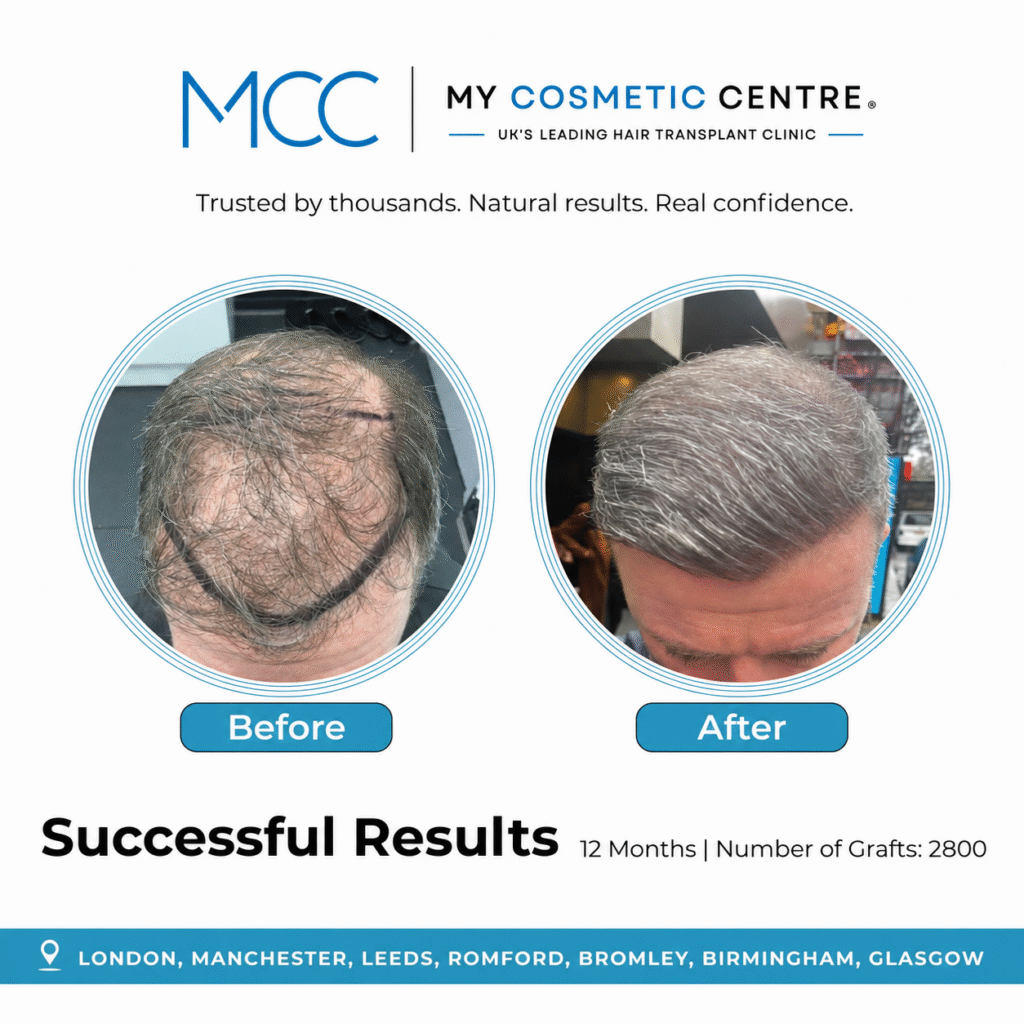 Before and after FUE hair transplant result at My Cosmetic Centre. Individual outcome, results vary.