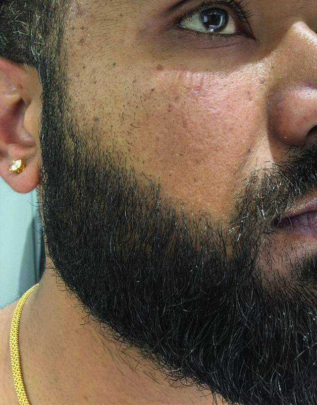 Beard transplant procedure
