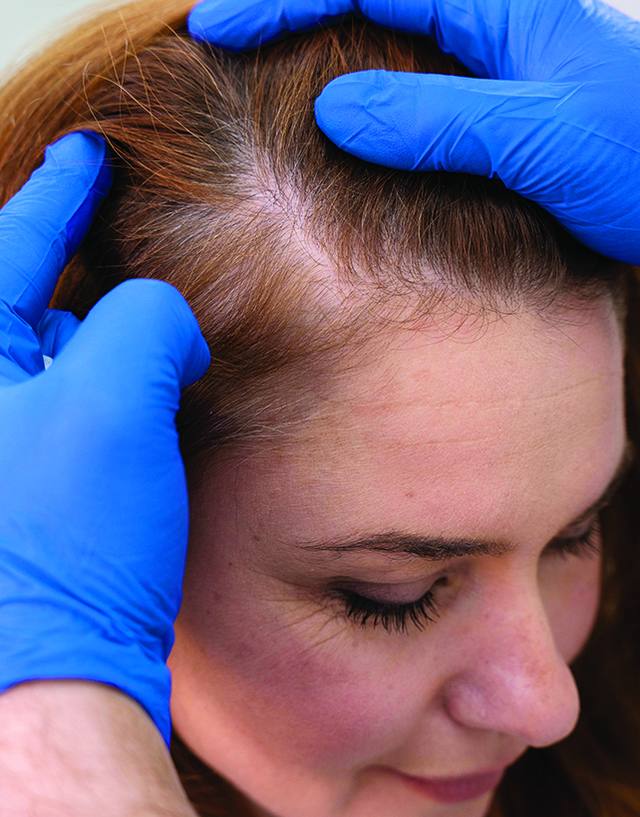 Hair loss treatment consultation for women