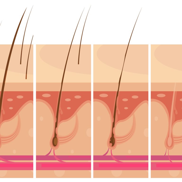 Hair loss storyboard conceptual compositions set with profile macro view of balding scalp skin infographic images vector illustration