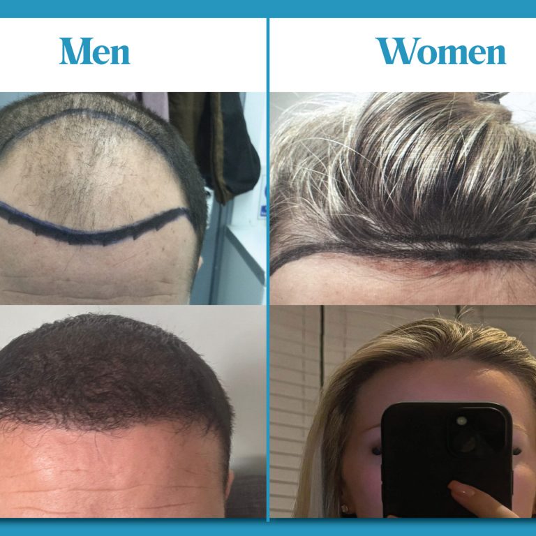 Effective Hair Loss Treatment for Men & Women in the UK