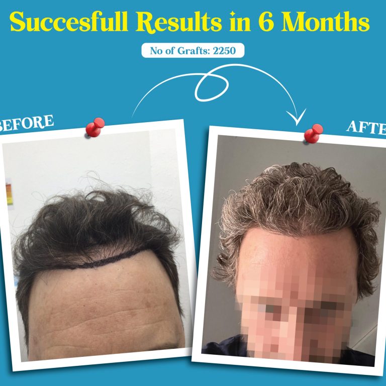 Effective Male Hair Thinning Treatment at My Cosmetic Centre UK