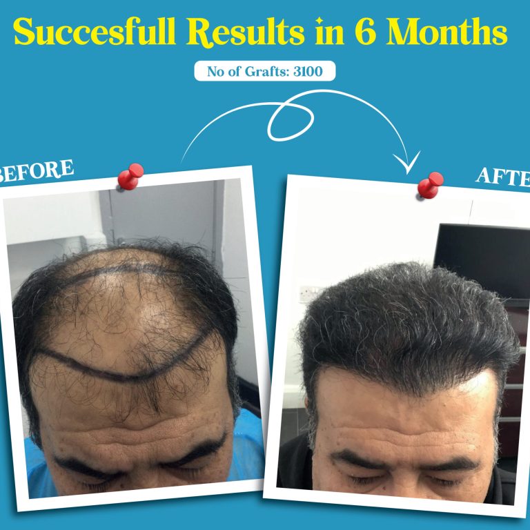 Effective Male Pattern Baldness Treatment Package at My Cosmetic Centre UK