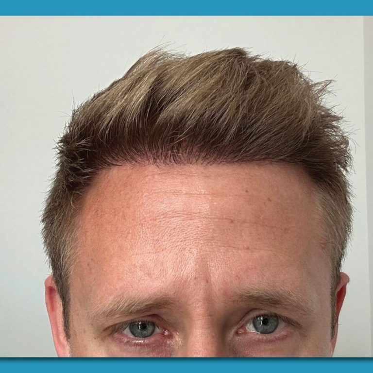 FUE Hair Transplant The Modern Solution for Hair Loss