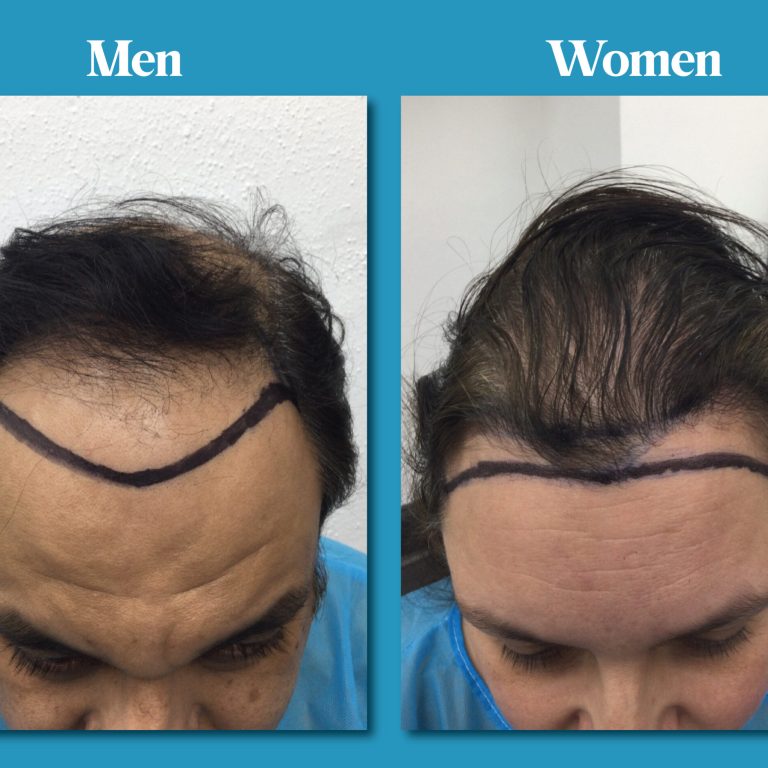 Top 10 Causes of Hair Loss in Men and Women in the UK