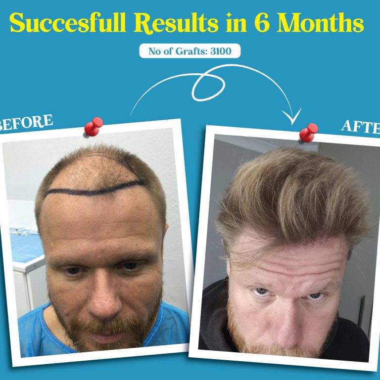 Top Hair Treatment for Men Restore Your Confidence Today