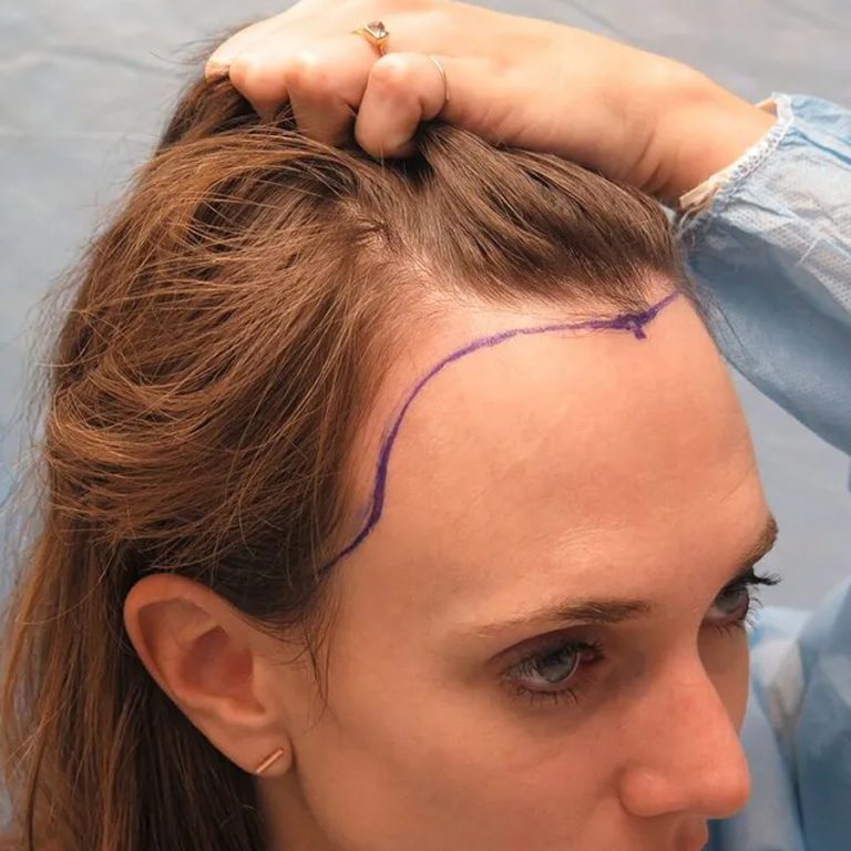 unshaven hair transplant (1)