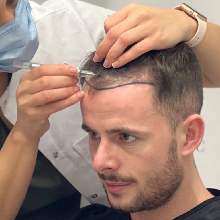 unshaven hair transplant